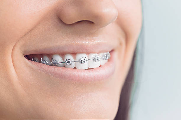 Dental Bonding in Venersborg, WA